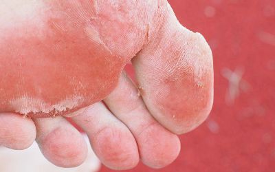 Athlete's foot