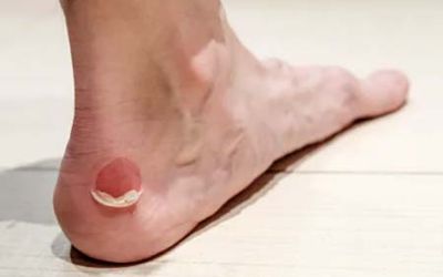 Nasty blister on heel
