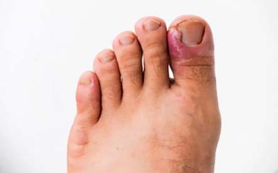 Foot with ingrown toenail